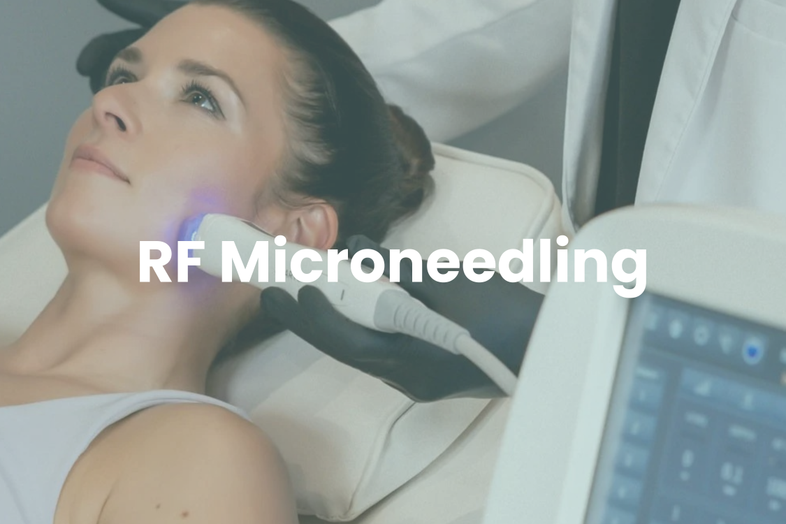 Radiofrequency Microneedling