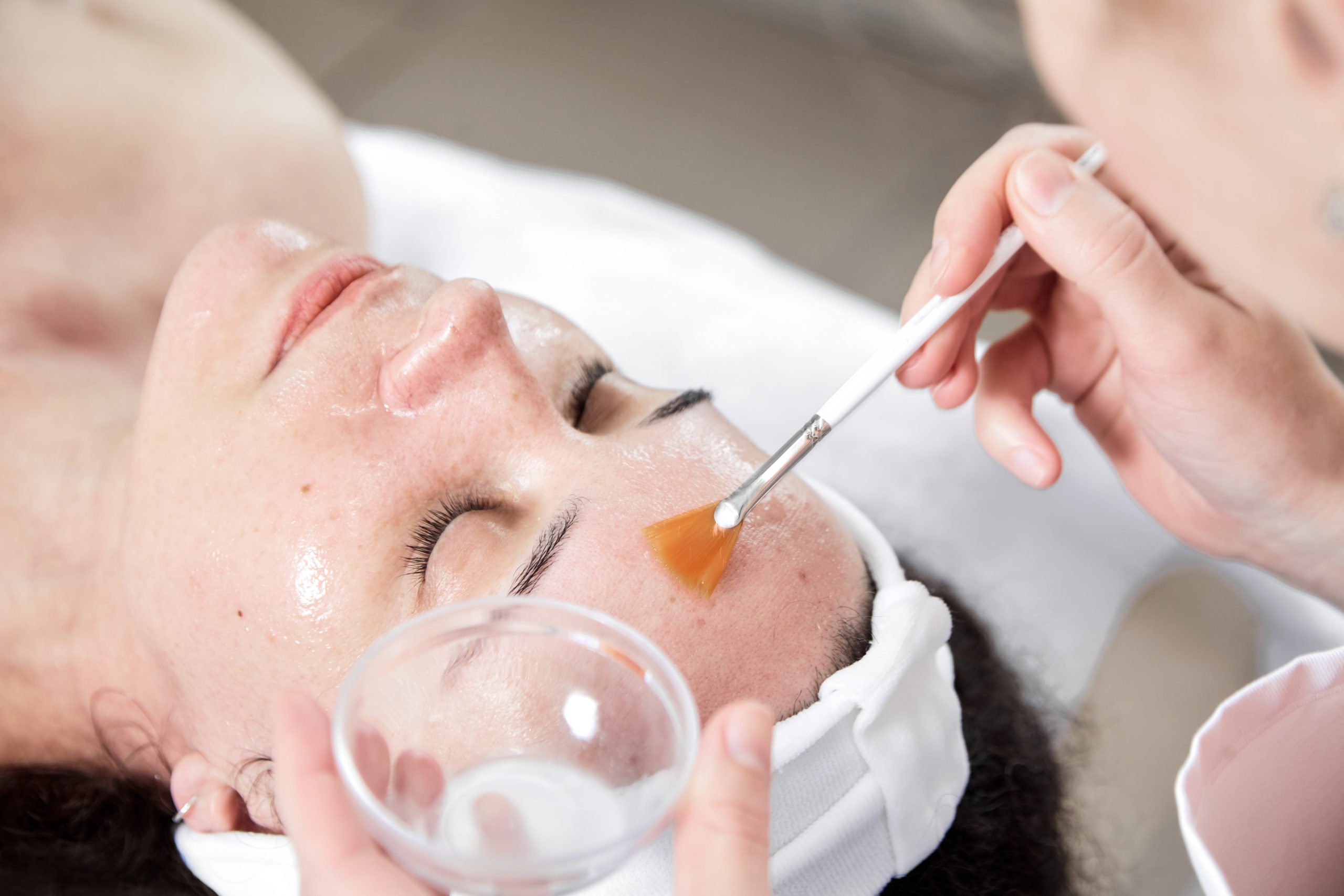 Chemical Peels
