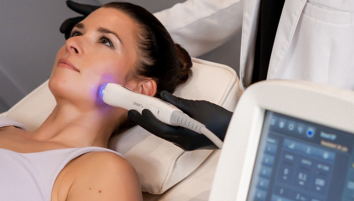 RF Microneedling