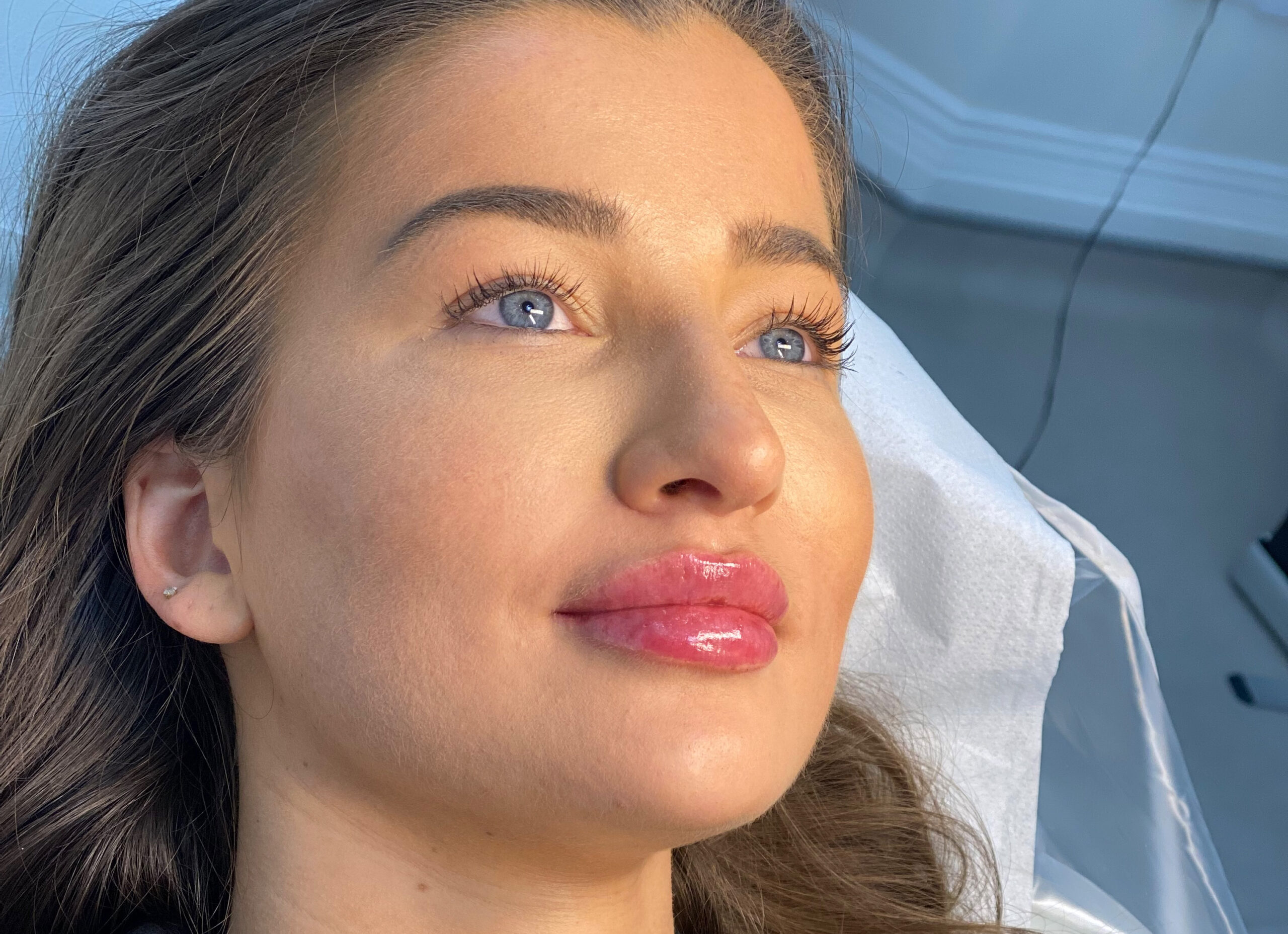 Lip Filler